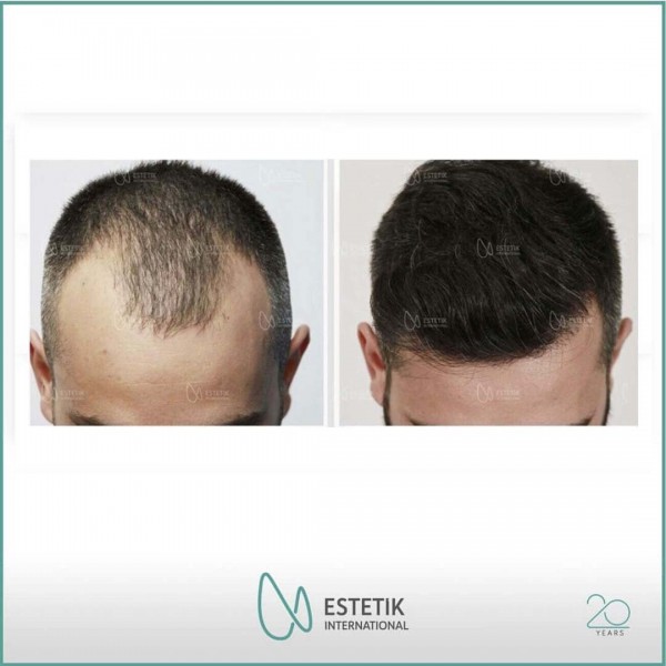 Haartransplantation 1