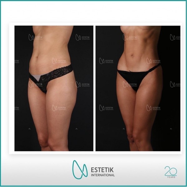 Bauchmuskelästhetik