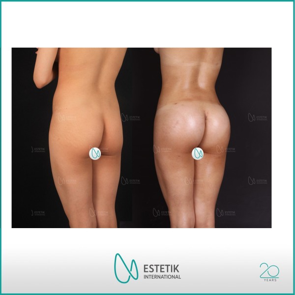 Brazilian Butt Lifting